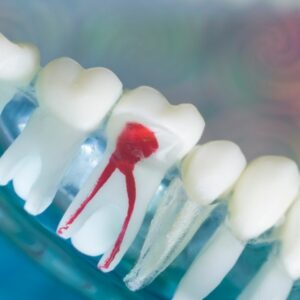Root Canal Treatment