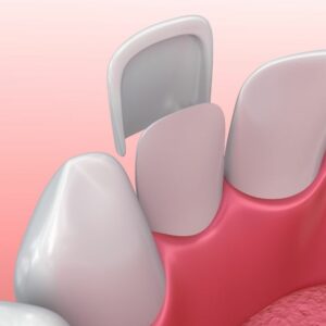 Porcelain Veneers