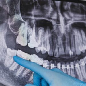 Wisdom Tooth Extraction