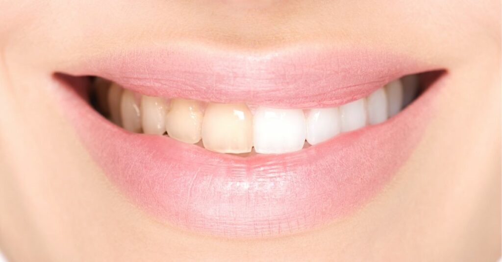 Teeth Bleaching Absolute Dental